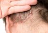 Saç Derisinde Neden Kabuklanma Olur?