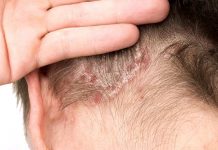 Saç Derisinde Neden Kabuklanma Olur?